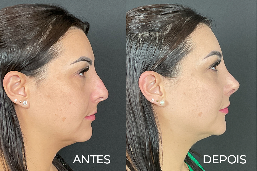 Resultado de rinoplastia 5 – antes e depois