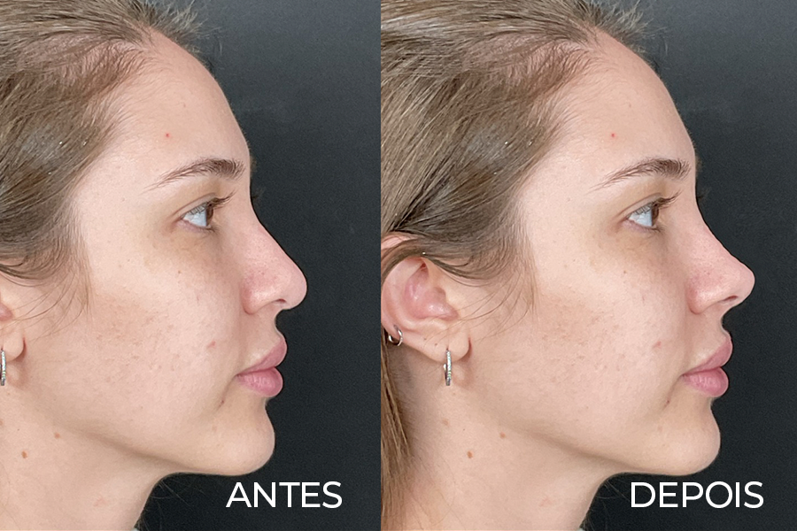 Resultado de rinoplastia 6 – antes e depois