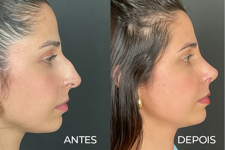 Resultado de rinoplastia 3 – antes e depois