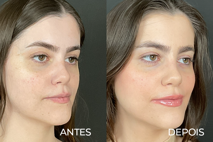 Resultado de rinoplastia 2 – antes e depois