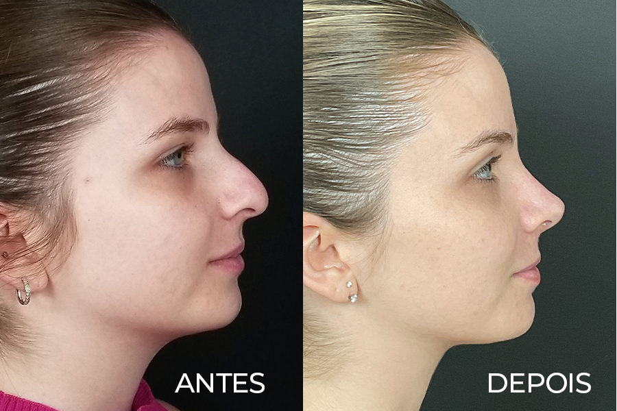 Resultado de rinoplastia 4 – antes e depois